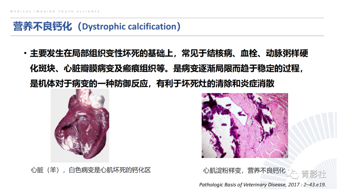 【PPT】胸部钙化临床意义和疾病谱-4
