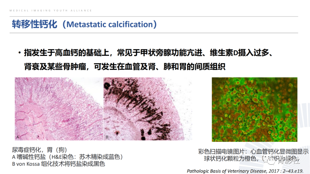 【PPT】胸部钙化临床意义和疾病谱-5