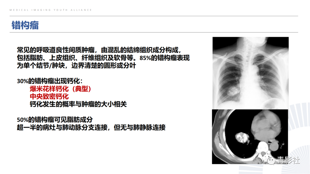 【PPT】胸部钙化临床意义和疾病谱-10