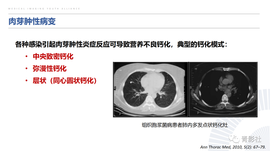【PPT】胸部钙化临床意义和疾病谱-11