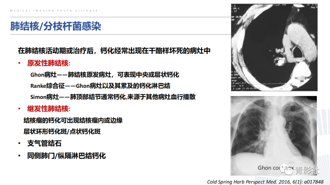 【PPT】胸部钙化临床意义和疾病谱-13