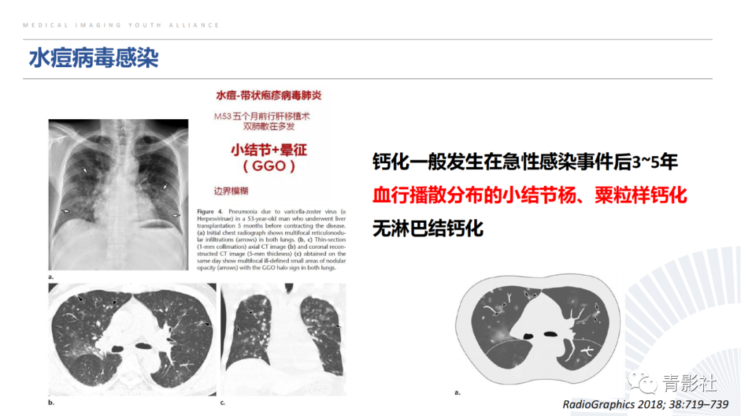 【PPT】胸部钙化临床意义和疾病谱-14