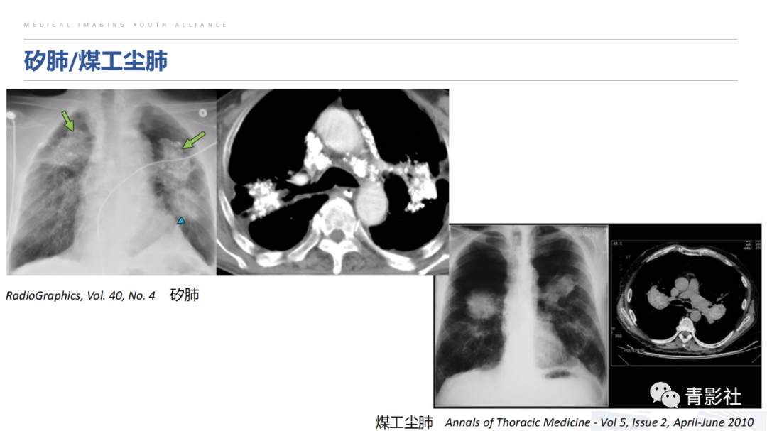 【PPT】胸部钙化临床意义和疾病谱-16