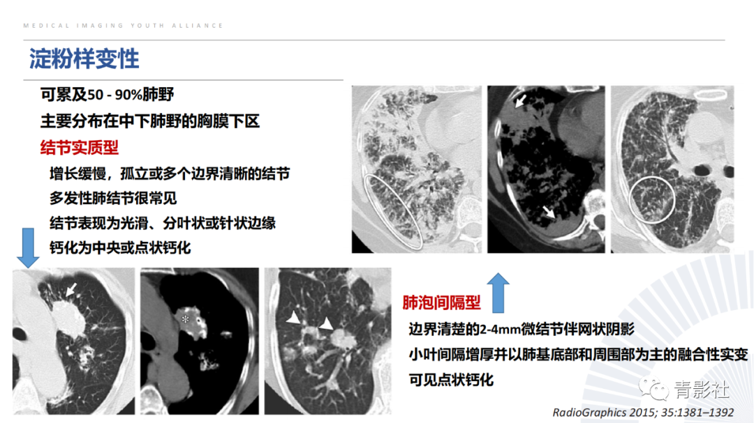 【PPT】胸部钙化临床意义和疾病谱-17