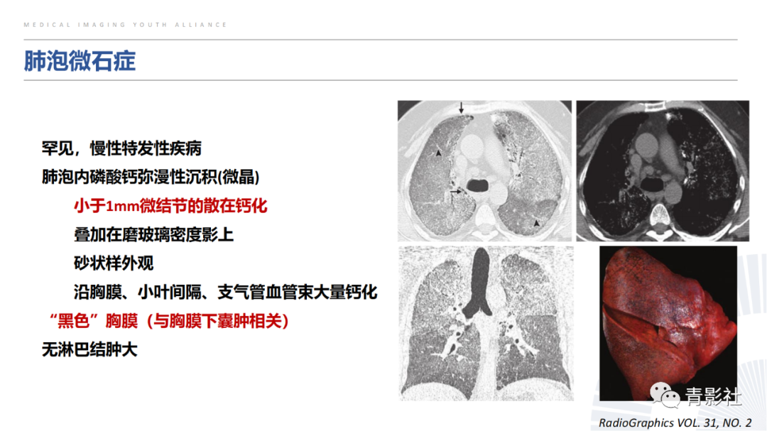 【PPT】胸部钙化临床意义和疾病谱-18