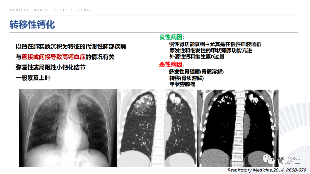 【PPT】胸部钙化临床意义和疾病谱-19