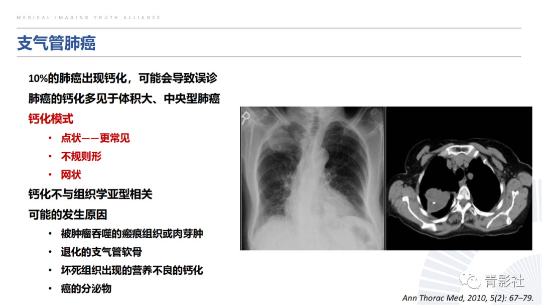 【PPT】胸部钙化临床意义和疾病谱-20