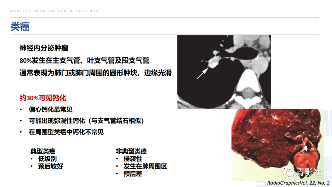 【PPT】胸部钙化临床意义和疾病谱-21