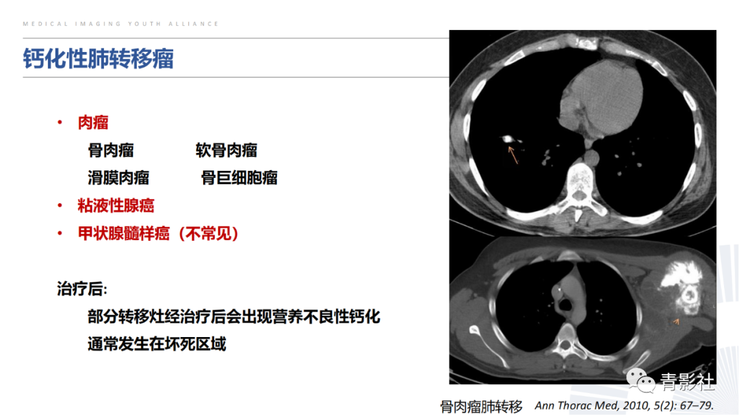 【PPT】胸部钙化临床意义和疾病谱-22