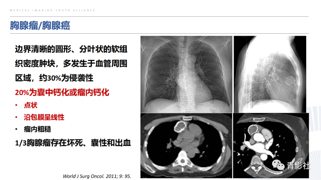 【PPT】胸部钙化临床意义和疾病谱-24