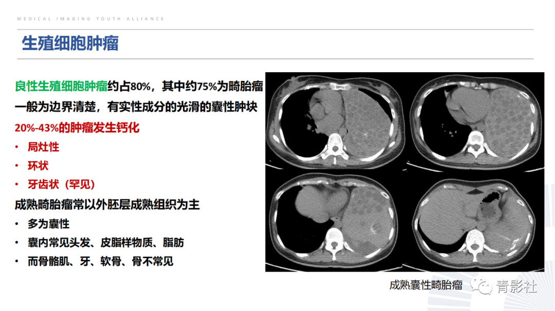 【PPT】胸部钙化临床意义和疾病谱-25