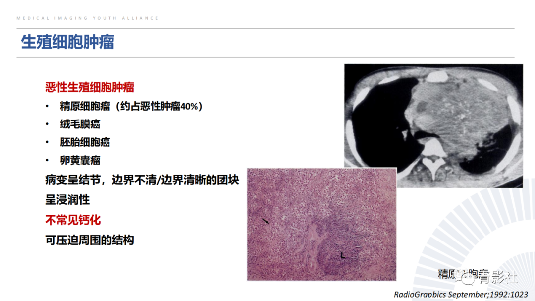 【PPT】胸部钙化临床意义和疾病谱-26