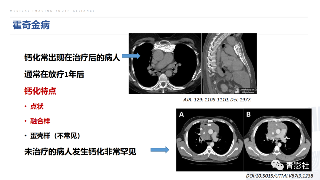 【PPT】胸部钙化临床意义和疾病谱-27