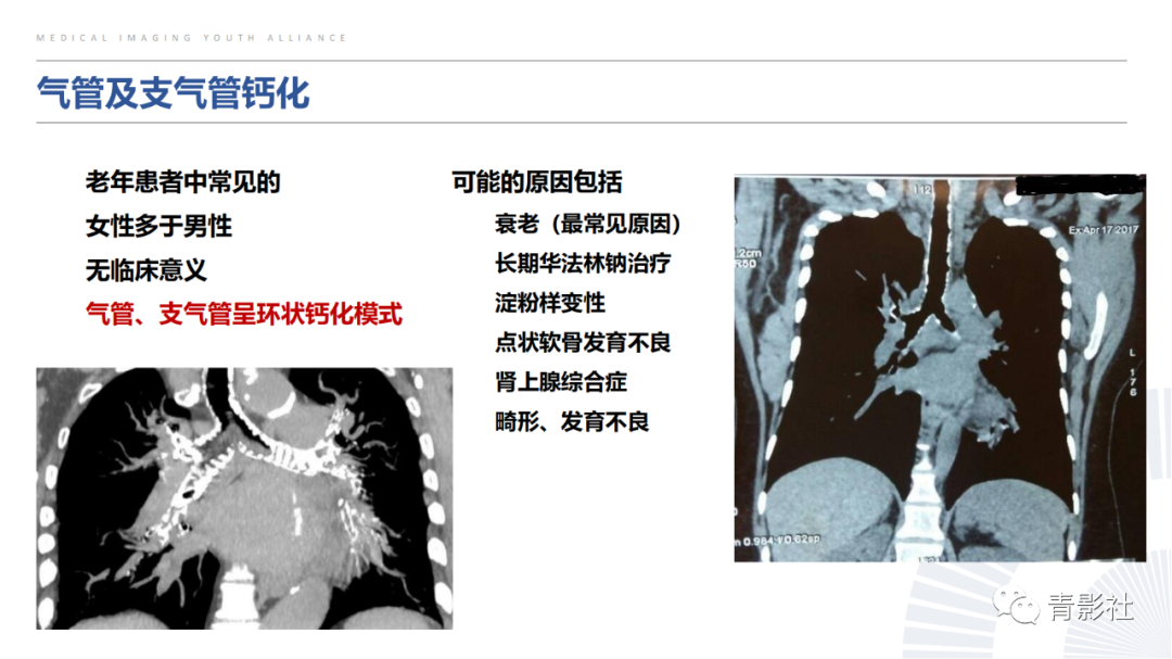 【PPT】胸部钙化临床意义和疾病谱-29