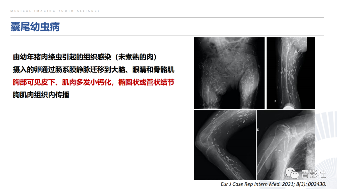 【PPT】胸部钙化临床意义和疾病谱-32