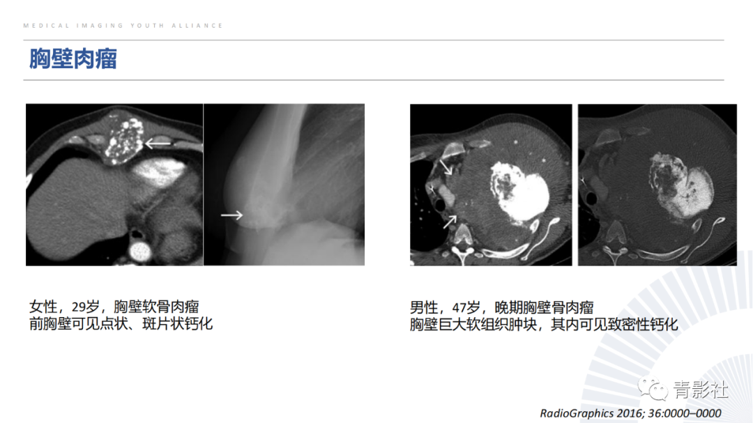 【PPT】胸部钙化临床意义和疾病谱-34