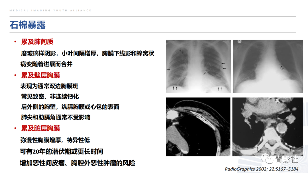 【PPT】胸部钙化临床意义和疾病谱-35