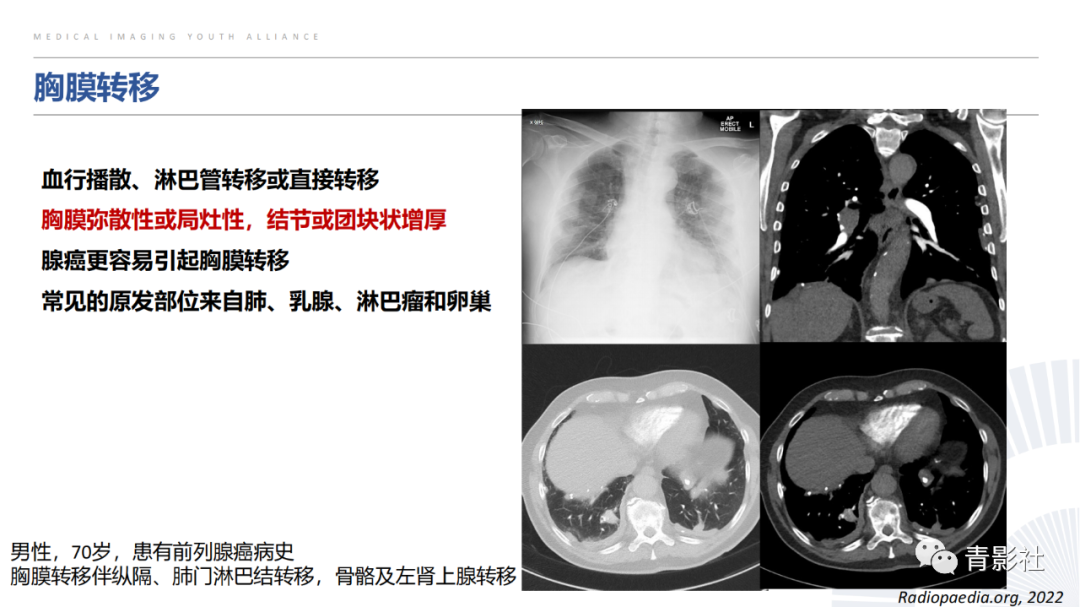 【PPT】胸部钙化临床意义和疾病谱-36