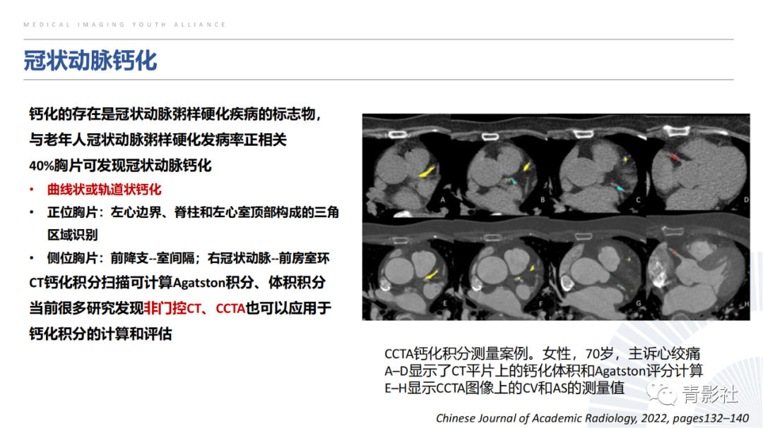 【PPT】胸部钙化临床意义和疾病谱-38