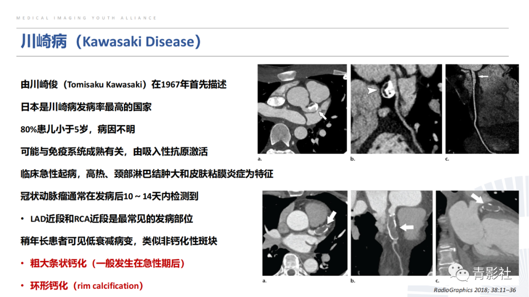 【PPT】胸部钙化临床意义和疾病谱-39