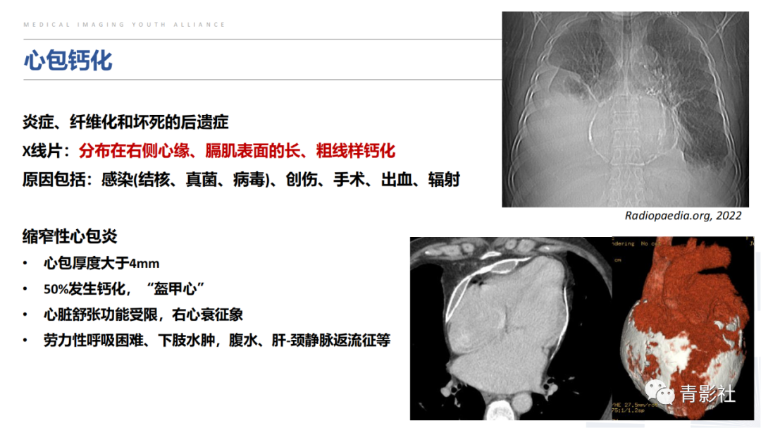 【PPT】胸部钙化临床意义和疾病谱-40