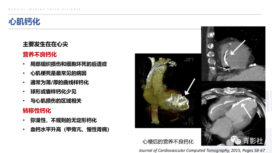 【PPT】胸部钙化临床意义和疾病谱-41