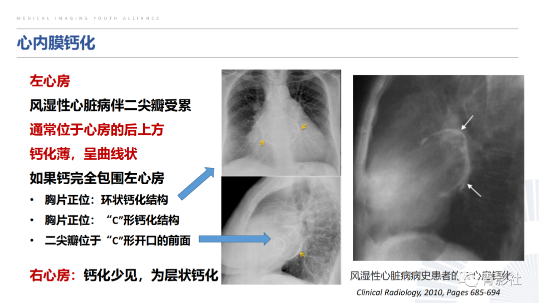 【PPT】胸部钙化临床意义和疾病谱-42