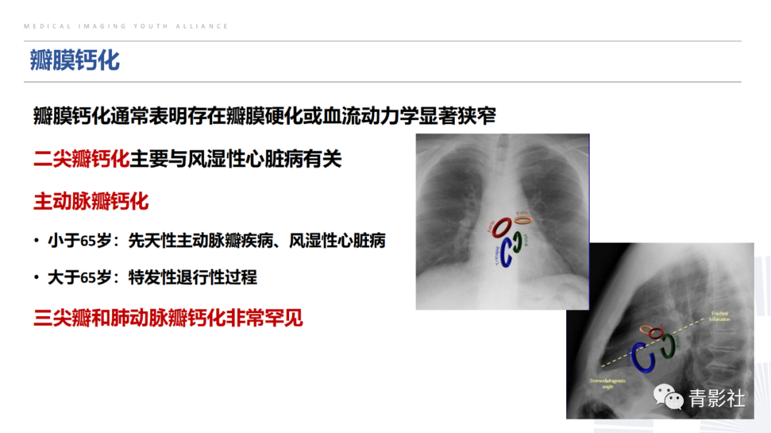 【PPT】胸部钙化临床意义和疾病谱-43