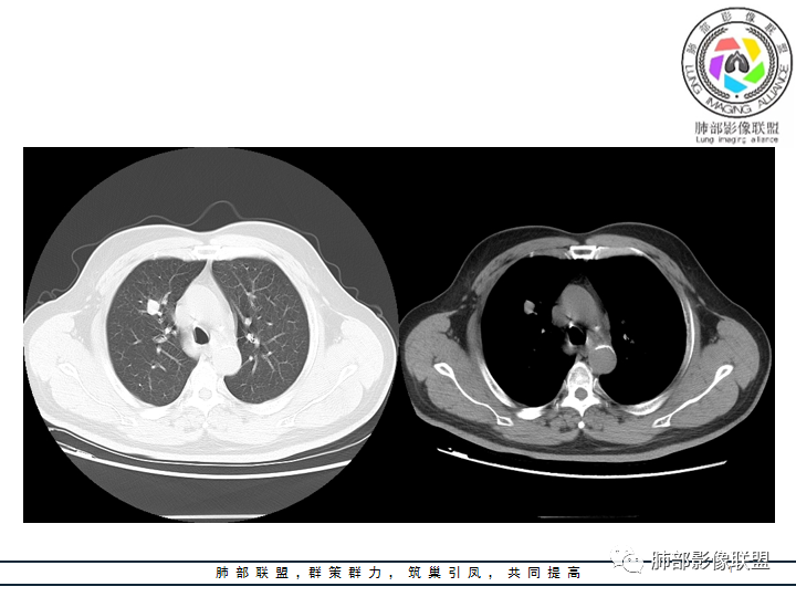 【病例】诡异的肺结节！-4