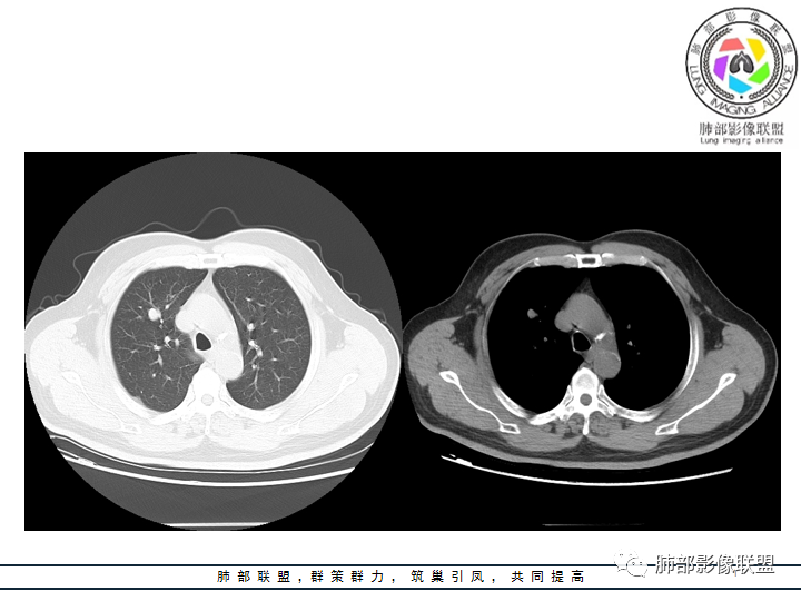 【病例】诡异的肺结节！-3