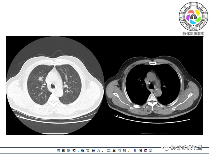 【病例】诡异的肺结节！-5