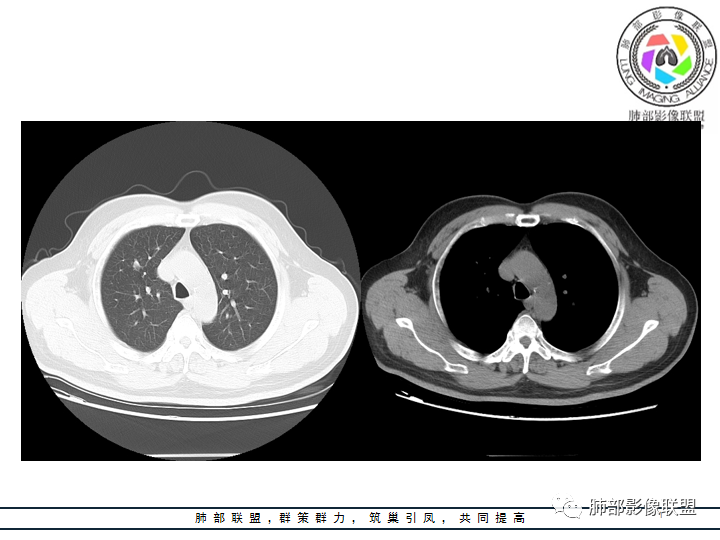 【病例】诡异的肺结节！-2