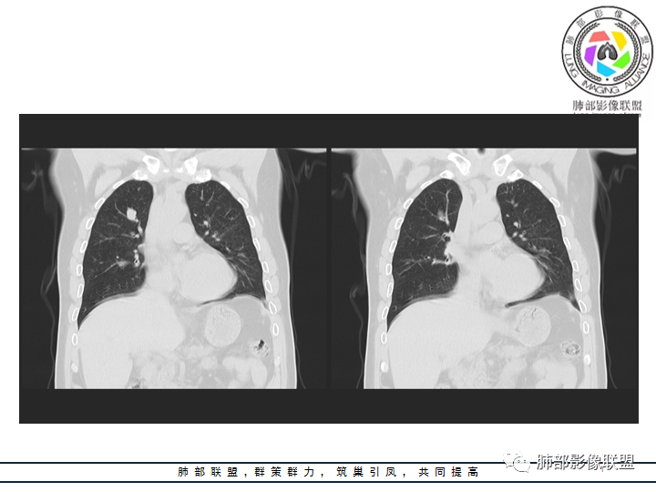 【病例】诡异的肺结节！-7