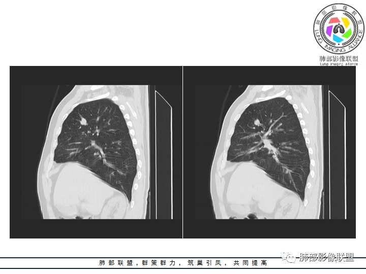【病例】诡异的肺结节！-8