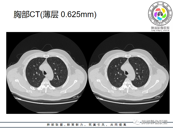 【病例】诡异的肺结节！-10