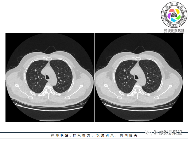 【病例】诡异的肺结节！-11