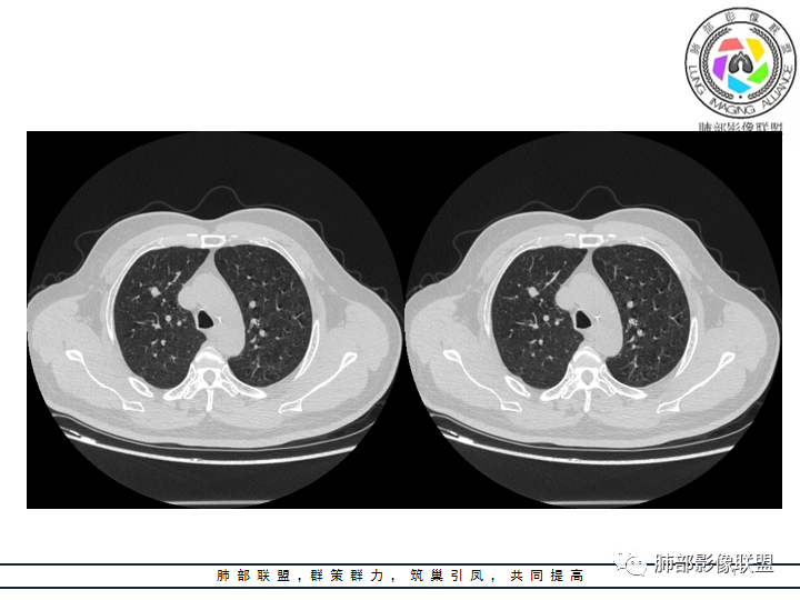 【病例】诡异的肺结节！-12