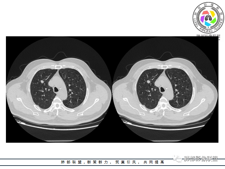 【病例】诡异的肺结节！-13