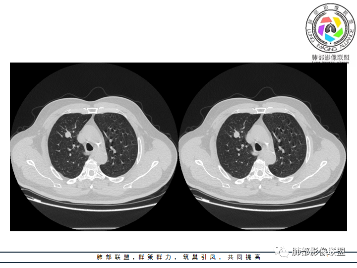 【病例】诡异的肺结节！-14