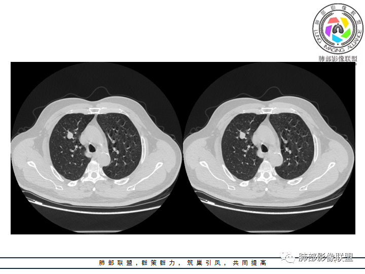 【病例】诡异的肺结节！-15