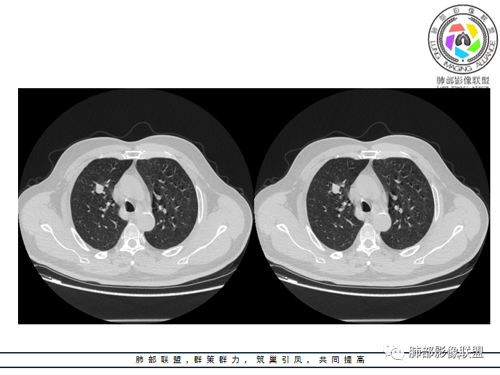 【病例】诡异的肺结节！-16