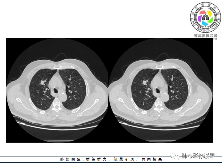 【病例】诡异的肺结节！-17