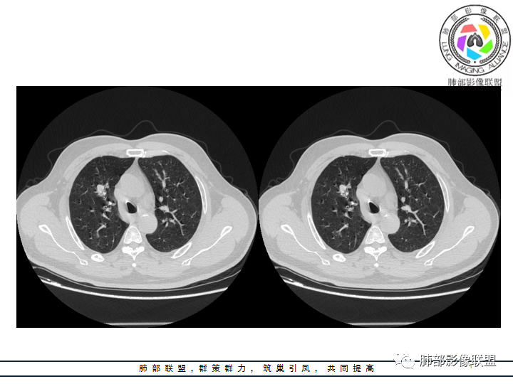 【病例】诡异的肺结节！-18