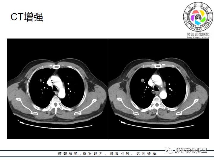 【病例】诡异的肺结节！-19
