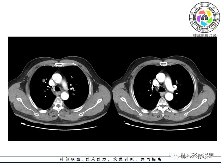 【病例】诡异的肺结节！-20
