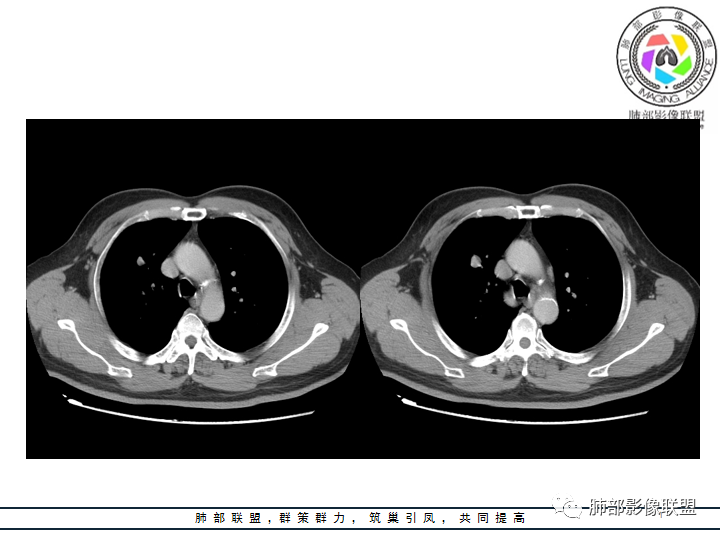 【病例】诡异的肺结节！-21