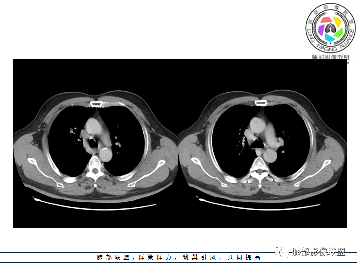 【病例】诡异的肺结节！-22