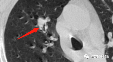 【病例】诡异的肺结节！-24