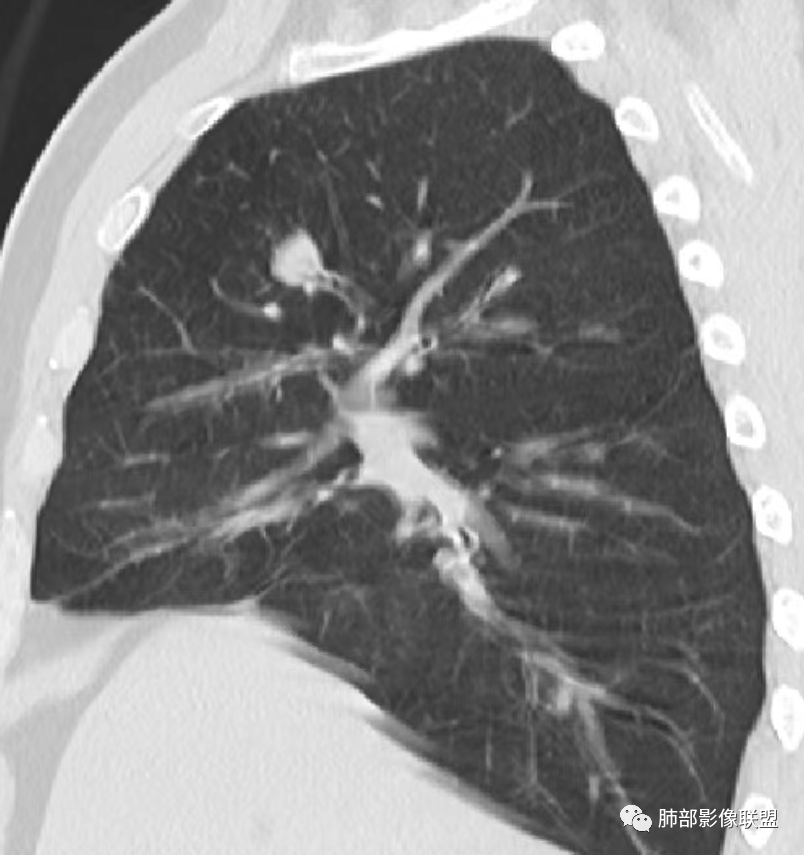 【病例】诡异的肺结节！-25