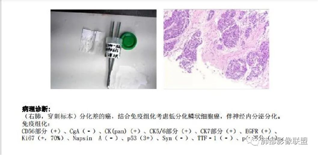 【病例】诡异的肺结节！-26